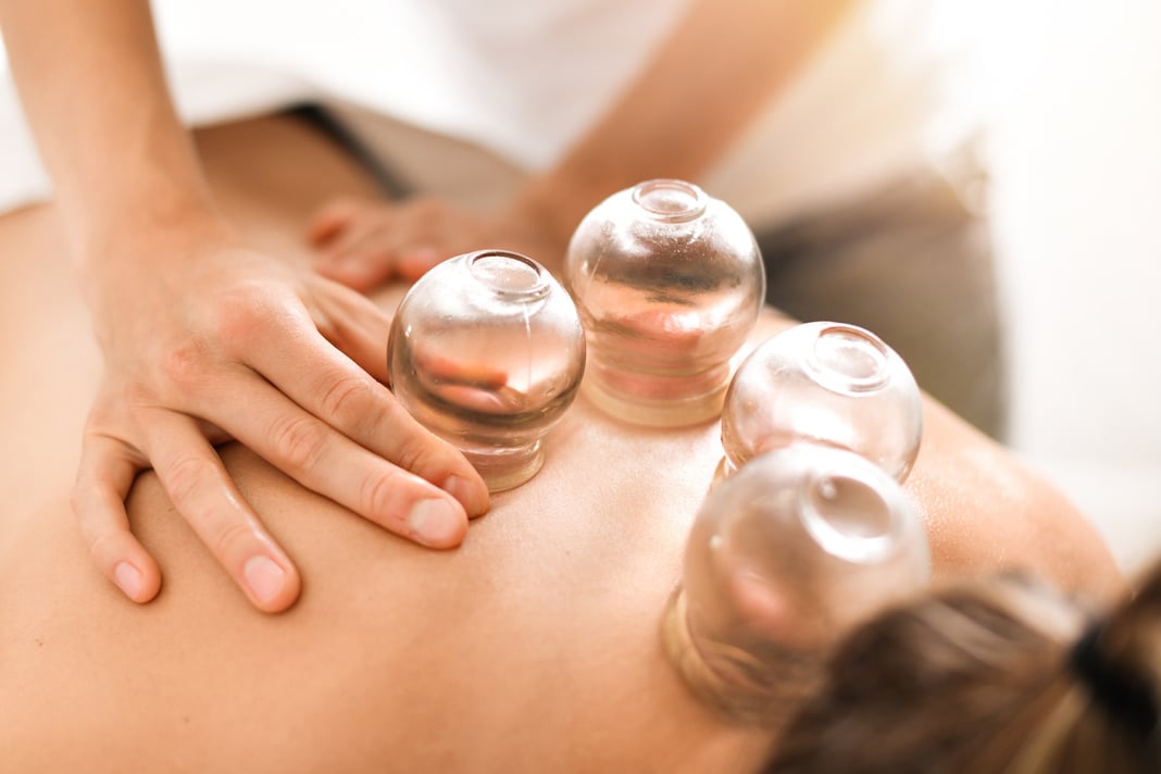 cupping-therapy-iStock