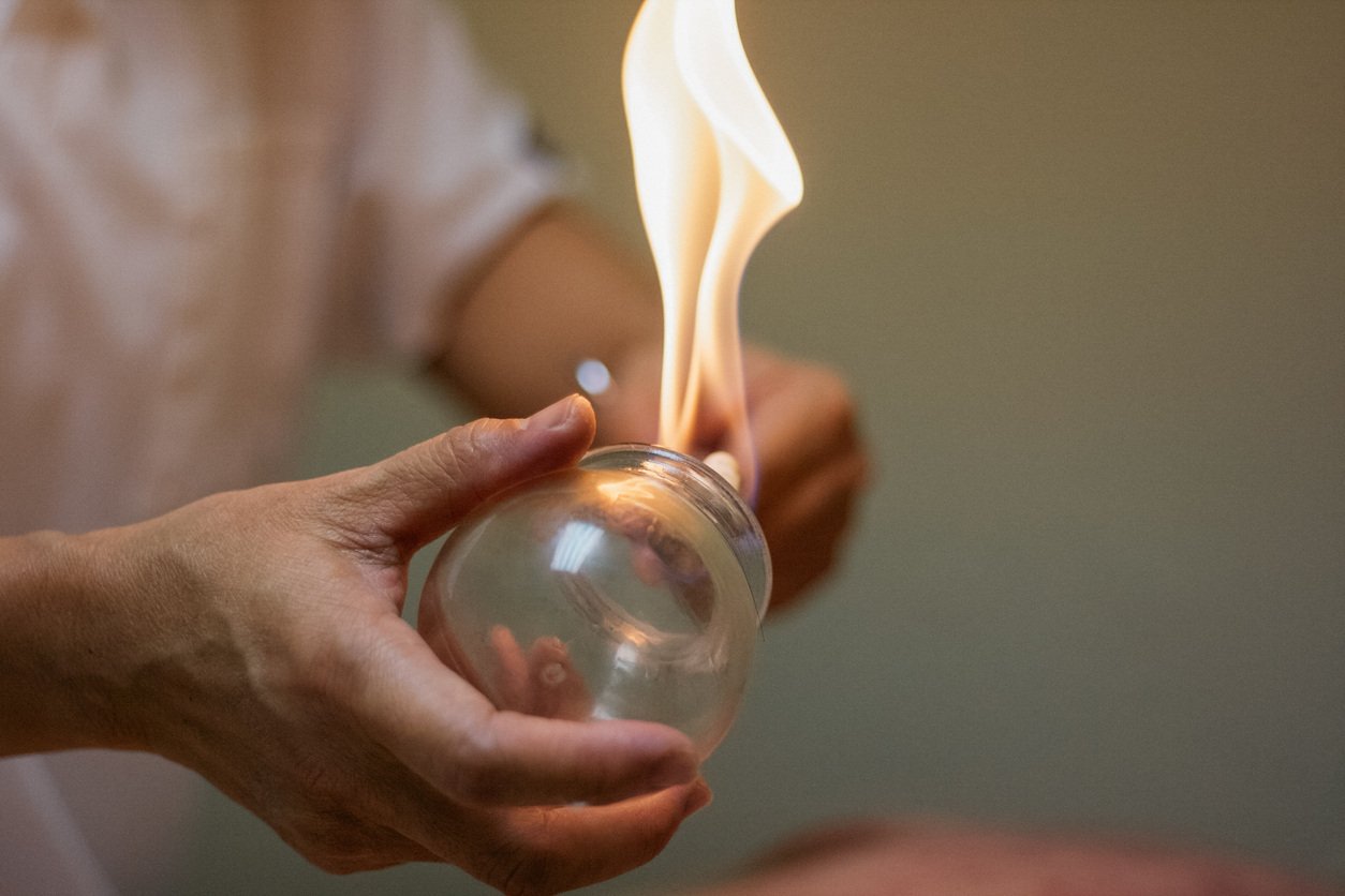 fire-cupping-therapy-iStock